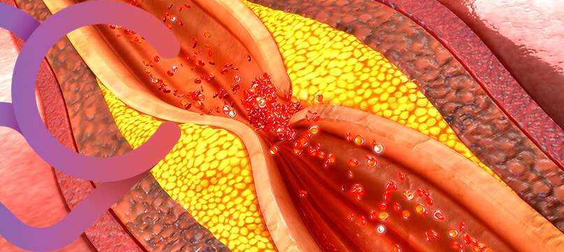 Imagem doença coronariana